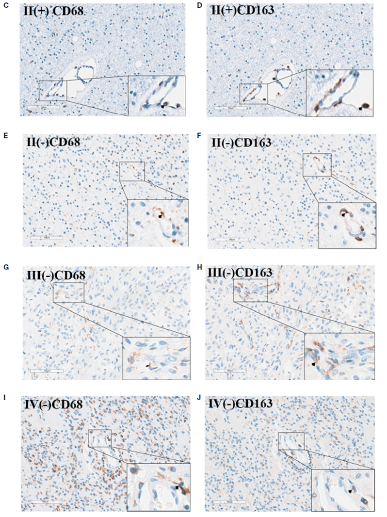 膠質(zhì)瘤中 MD2 的表達(dá)和生存分析